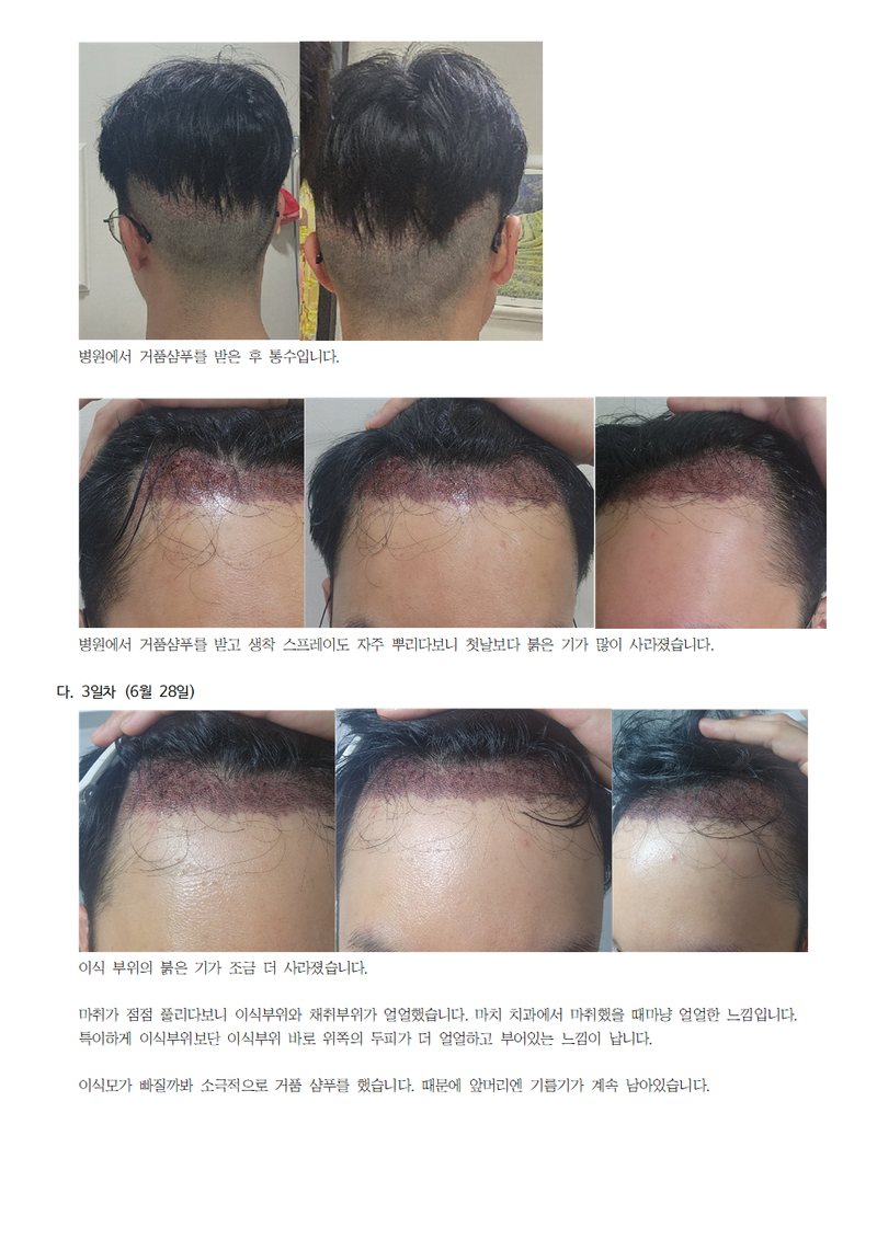 모모성형외과 모발이식 후기004.png