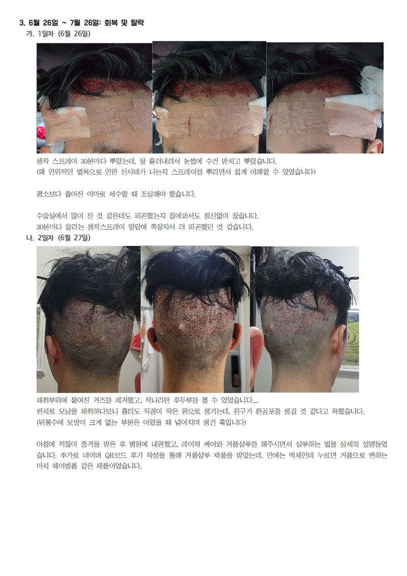 모모성형외과 모발이식 후기003.png