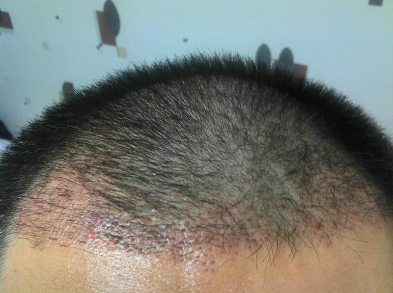 [Motion] Motion 1 month 1000 hair follicles.