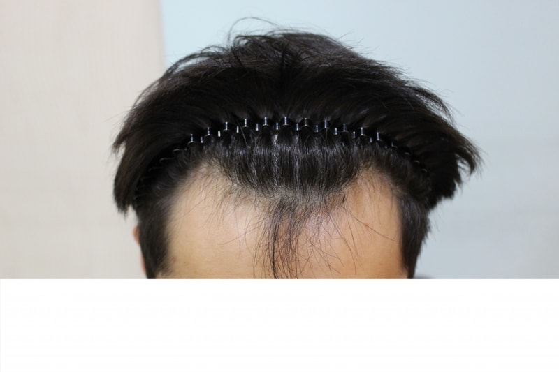 수술 전.jpg