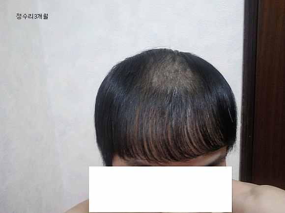 정수리3개월1.jpg