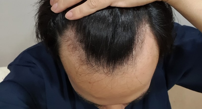 20대의 끄트머리에서 모발이식을 결정했습니다