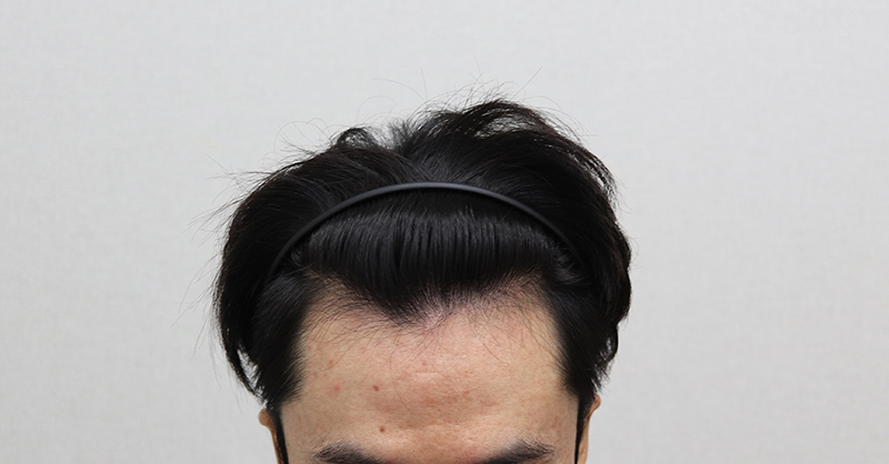 1.수술전.JPG