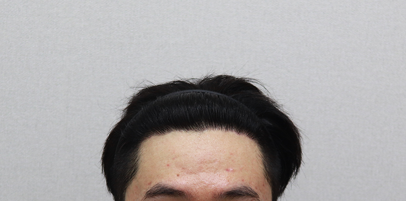 10.수술8개월차.JPG