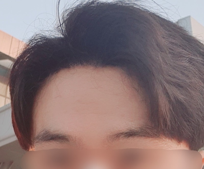 8.수술5개월차.jpg