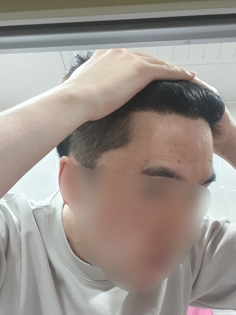9.수술8개월차2.jpg