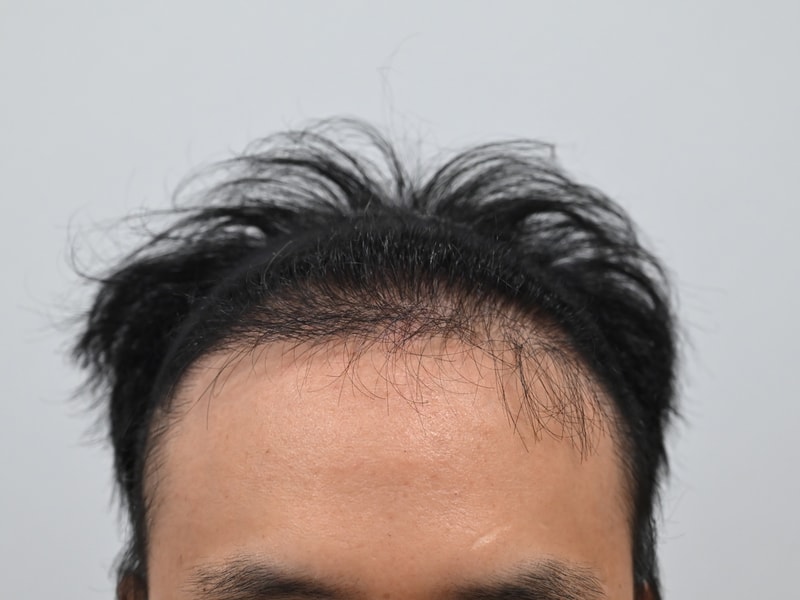 모엠의원 히든컷 모발이식 1년 경과 후기입니다.