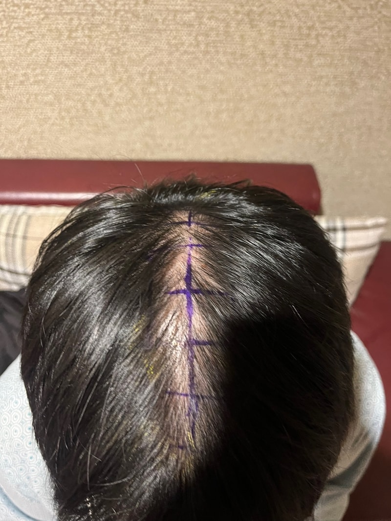 New hair / Non-cut hair transplant / 1500 hair follicles / Review immediately after day 2 shampoo