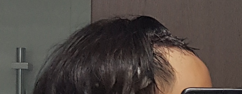 수술 후 당일6.jpg