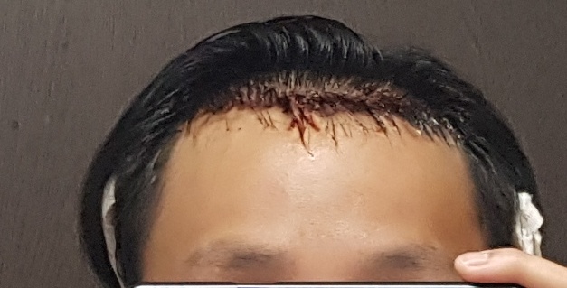 수술 후 당일3.jpg