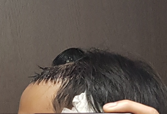 수술 후 당일7.jpg