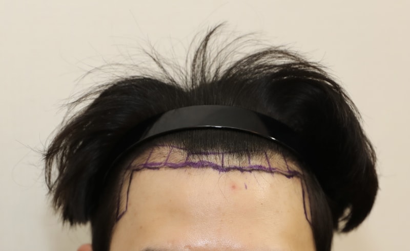 암흑기 존버 뉴헤어 비절개 1500 한달 후 뒷머리 사진 포함