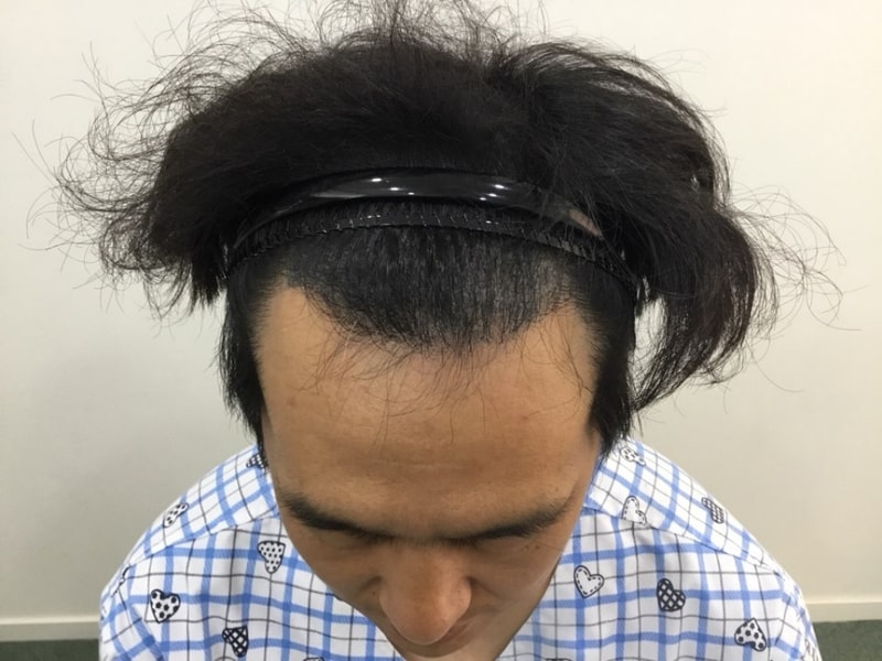 수술 전.jpg