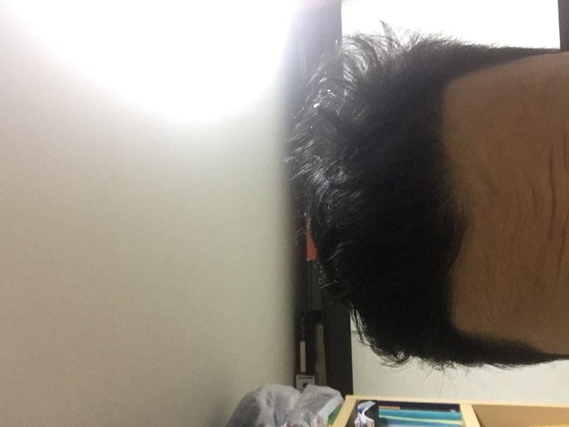 2600모  비절개  8개월차