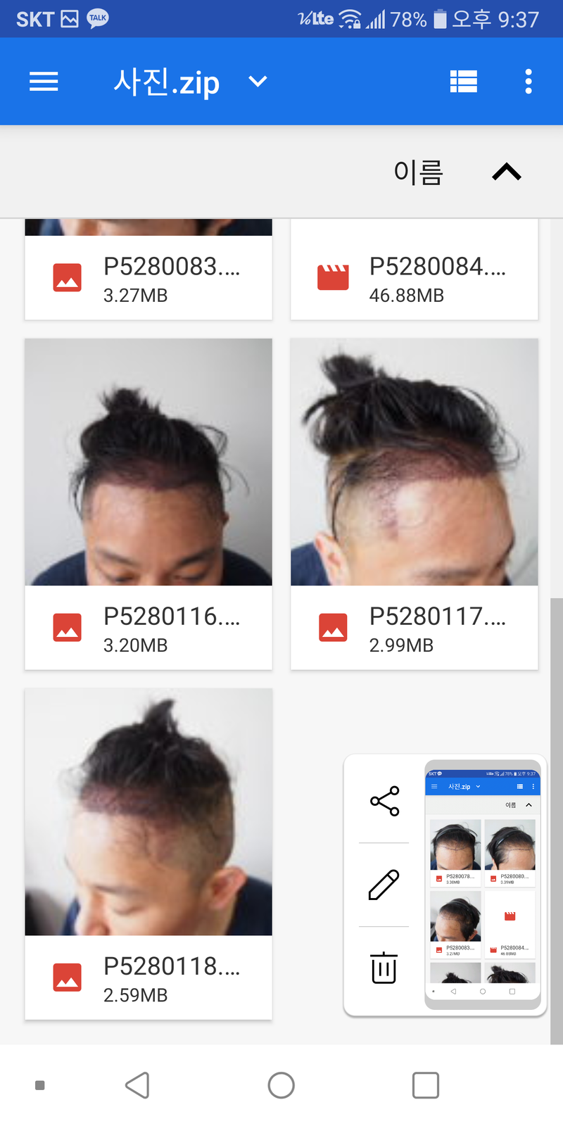 非切開母材性で手術しました~