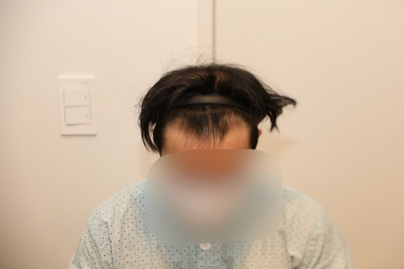 뉴헤어 비절개 삭발 5000모(2500모낭) 수술 후기입니다.