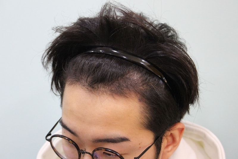 수술후 10일 (7).jpg