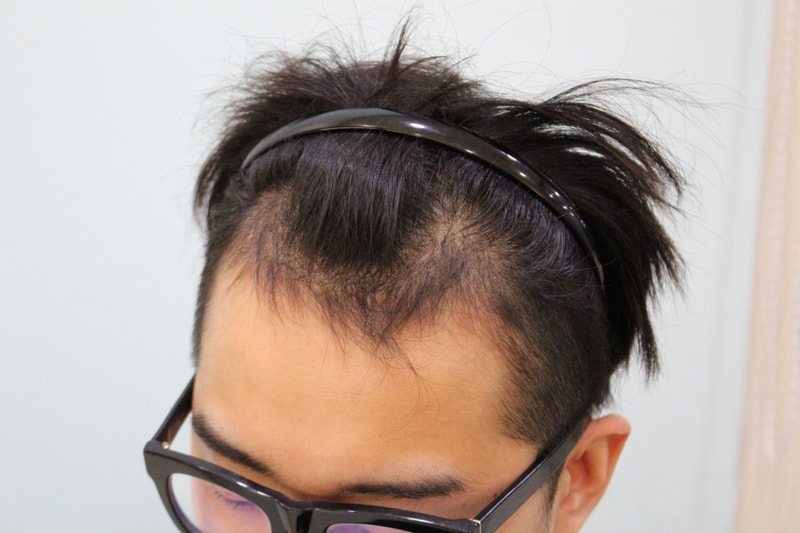 수술후 한달 (7).jpg