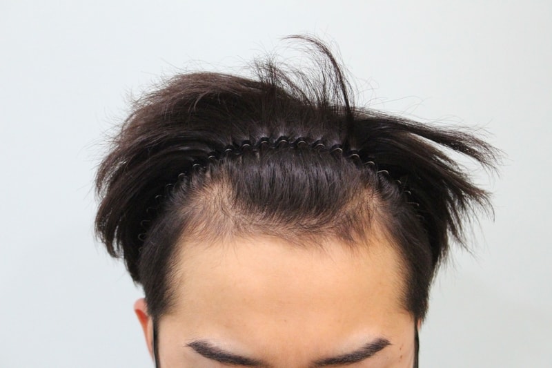 수술전 (1).jpg