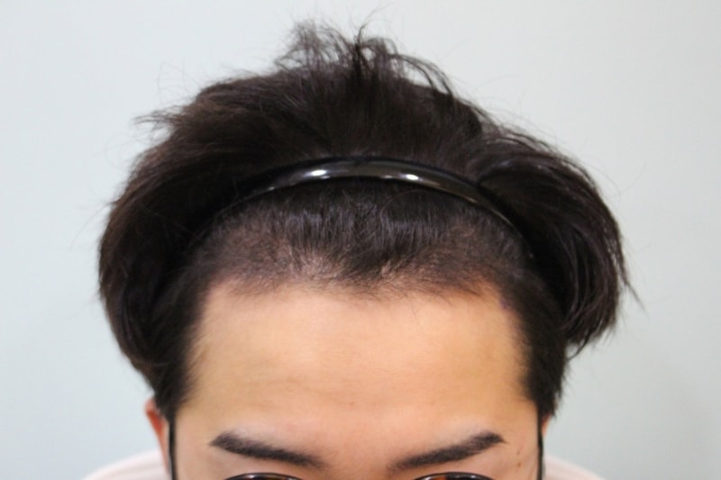 수술후 10일 (4).jpg