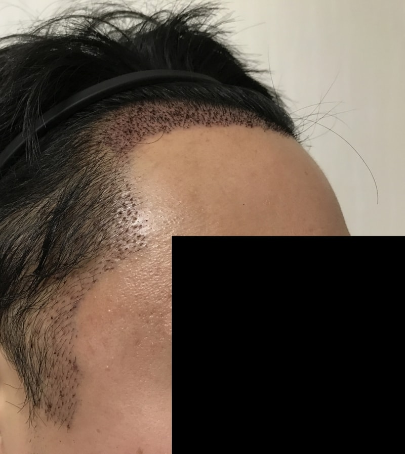 무삭발비절개 다나에서 어제 했습니다