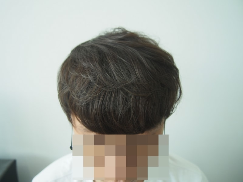 모재성 비절개 8개월차