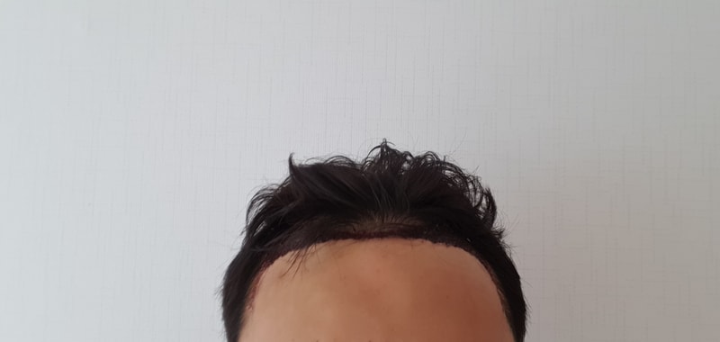 수술후 하루정도 지나고 찍었던사진입니다