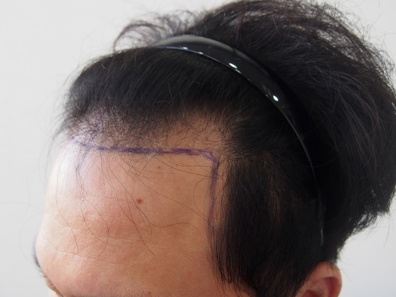02 수술 전 좌측면.JPG