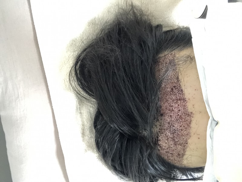 뉴헤어 비절개 1200모 밀도보강 후기