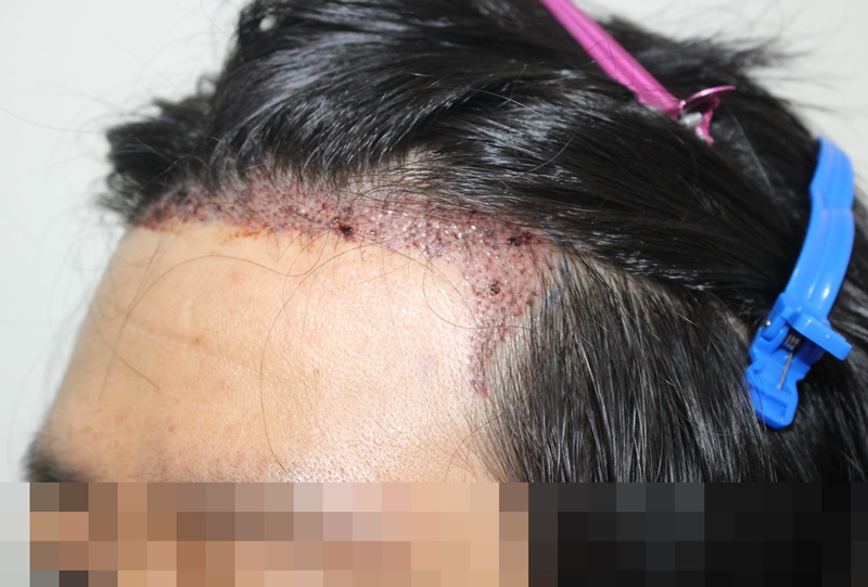 비절개 수술 후 1일차, 2주차 사진입니다