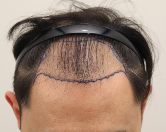 탈모극뽁.jpg