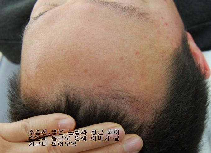 hair line before.JPG