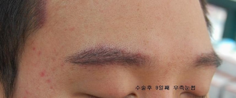 9day Rt brow.JPG