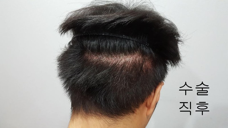 수술 직후3.jpg
