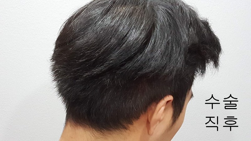 수술 직후4.jpg