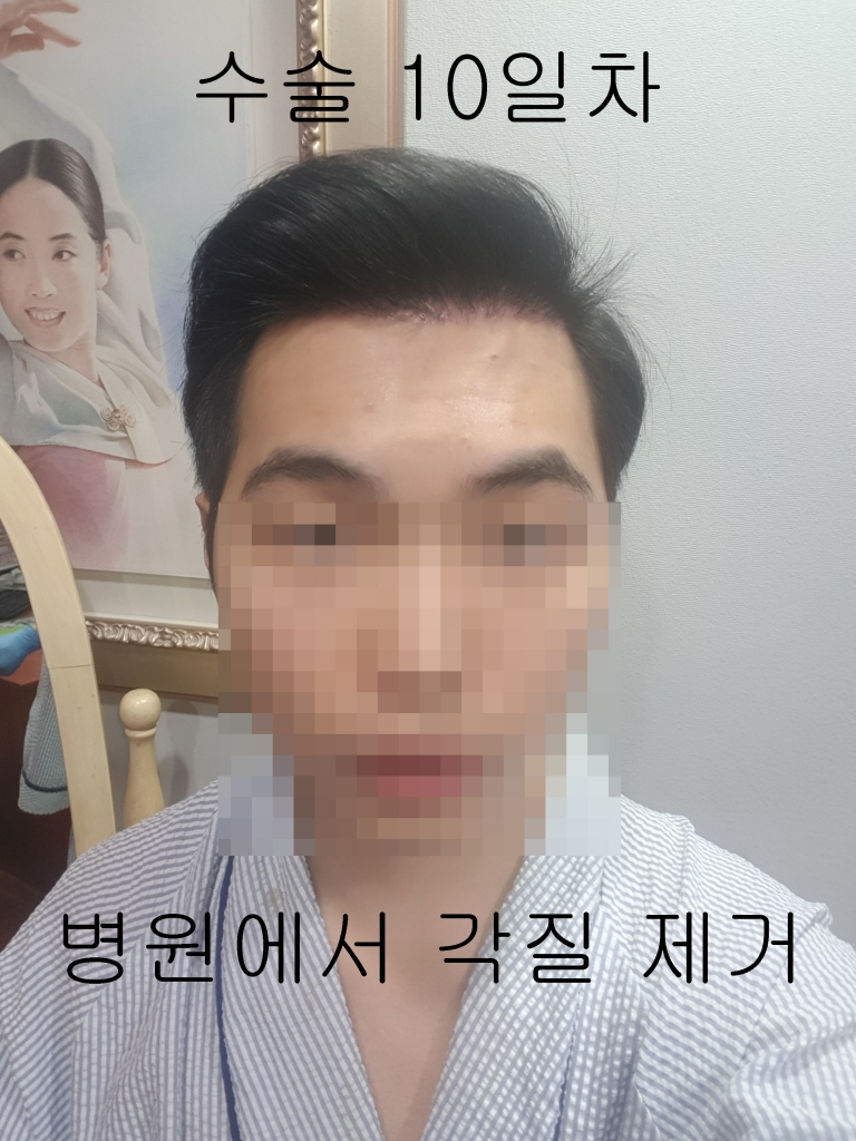 수술10일차.jpg