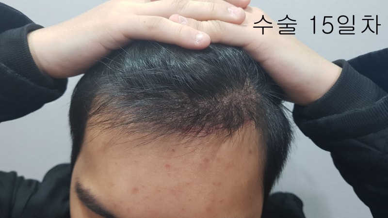 수술15일차.jpg
