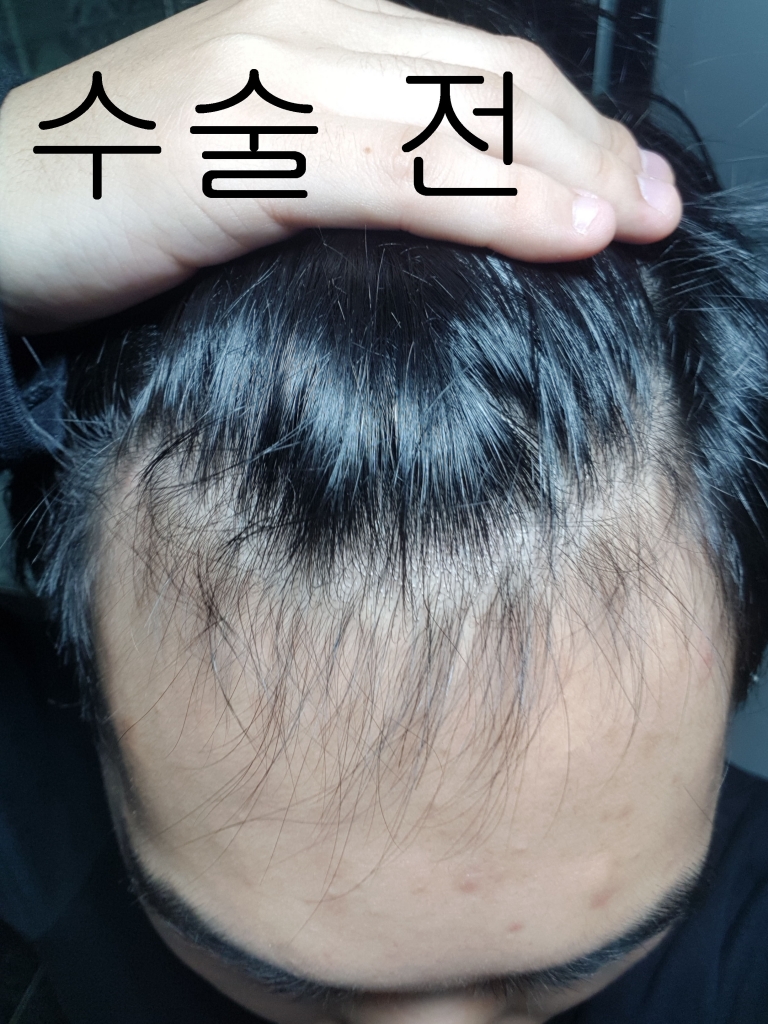 수술 전 사진.jpg