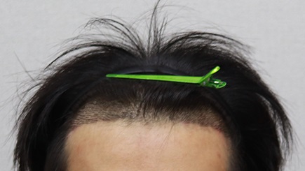 수술 14일차.jpg