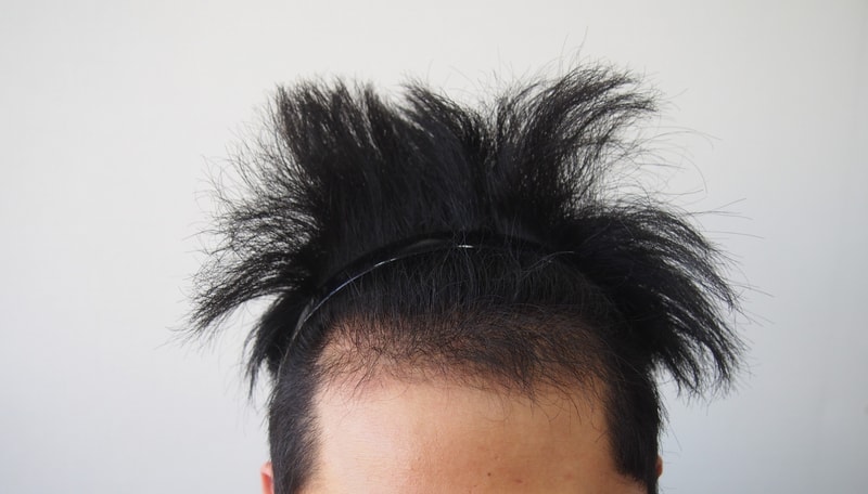 Post-mortem Immediately After Maternal 1011 Hair follicle Surgery