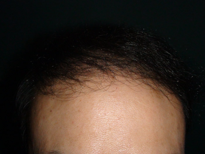 준섭,술후,정면,s.jpg