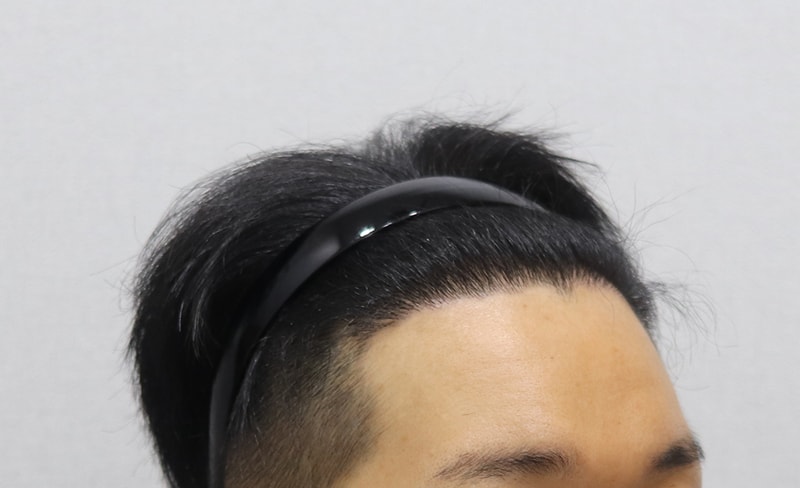 수술후 우측.JPG