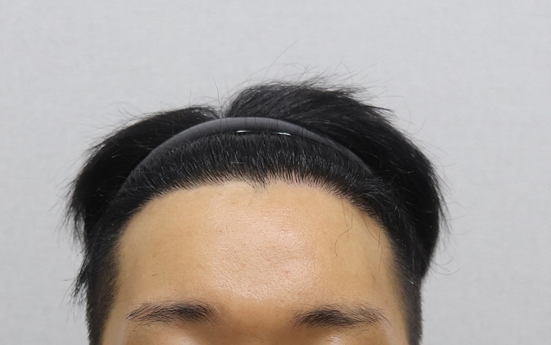 수술 후 정면.jpg