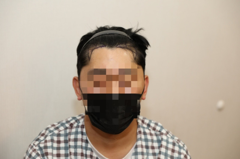 엠자 모발이식 비절개 후기