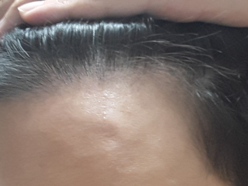 Day 180 of Hair Transplantation / Day 180 of Avodat