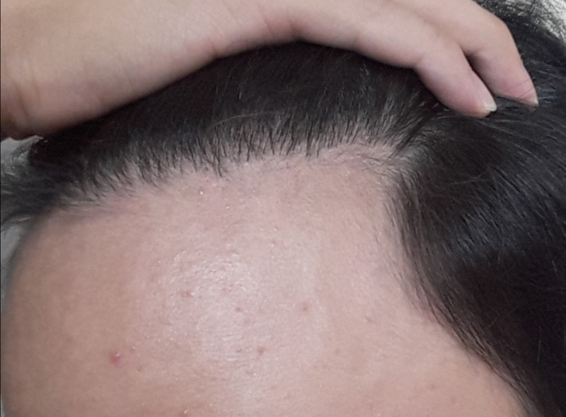Day 210 of Hair Transplantation / Day 210 of Avodat