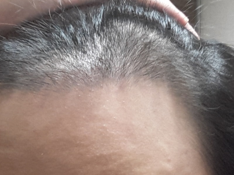 Day 90 of Hair Transplantation / Day 90 of Avodat