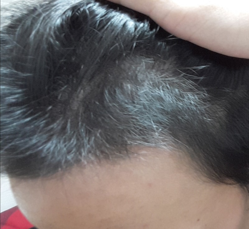 Day 120 of Hair Transplantation / Day 120 of Avodat