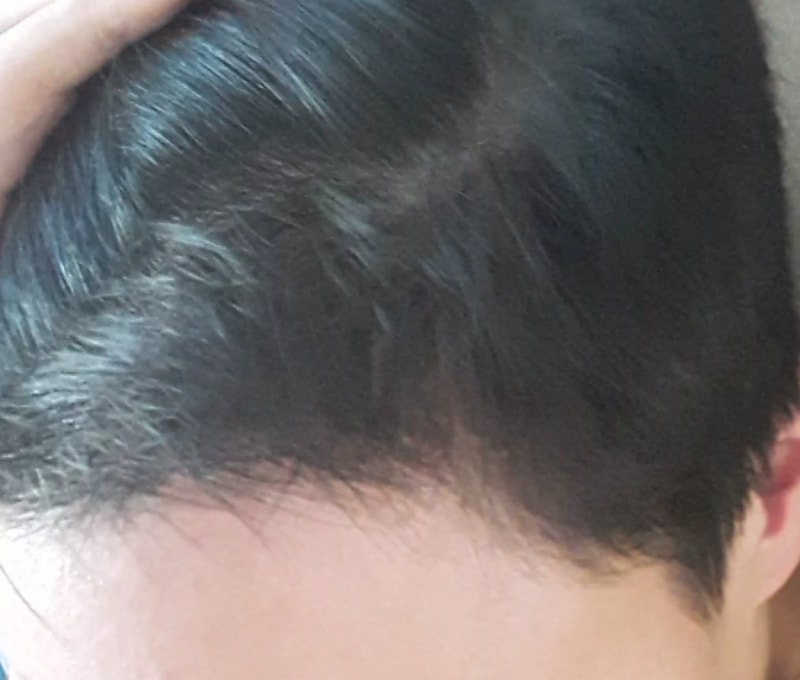 Day 150 of Hair Transplantation / Day 150 of Avodat