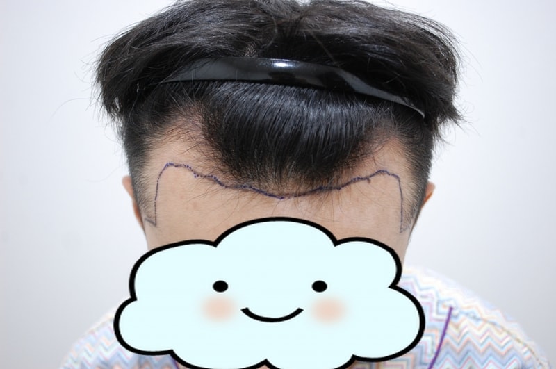 비절개 10일차입니다.